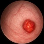 Bladder tumor found during cystoscopy