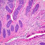 Can bladder inflammation be triggered by immune system dysfunction?