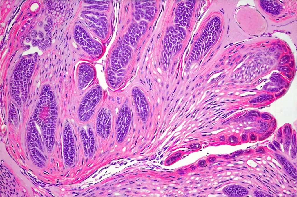 Can bladder inflammation be triggered by immune system dysfunction?