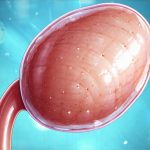Can cystitis develop from an allergic reaction to condoms?