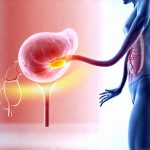 How to manage bladder irritation when you have other chronic pain