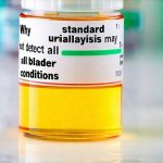 Why standard urinalysis may not detect all bladder conditions