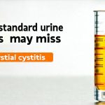 Why standard urine tests may miss interstitial cystitis